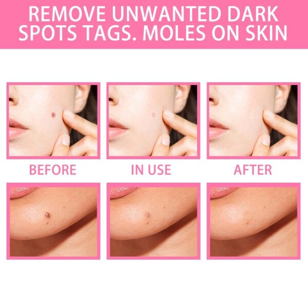 Organic Tags Solutions Serum No Trace Painle Skin Tag Remover Serum Mole Removal Cream Painless Face Wart Mole Freckle - Image 2