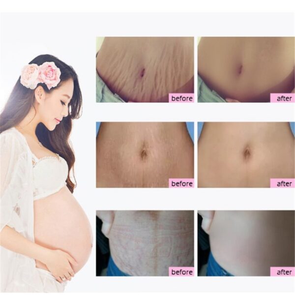 Natural Mild Non-irritating Mango Remove Stretch Mark Cream For Pregnancy Repair Scar Slack Line Abdomen Stretch Marks Cream - Image 3