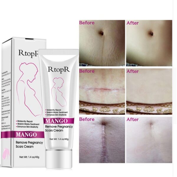 Natural Mild Non-irritating Mango Remove Stretch Mark Cream For Pregnancy Repair Scar Slack Line Abdomen Stretch Marks Cream - Image 2